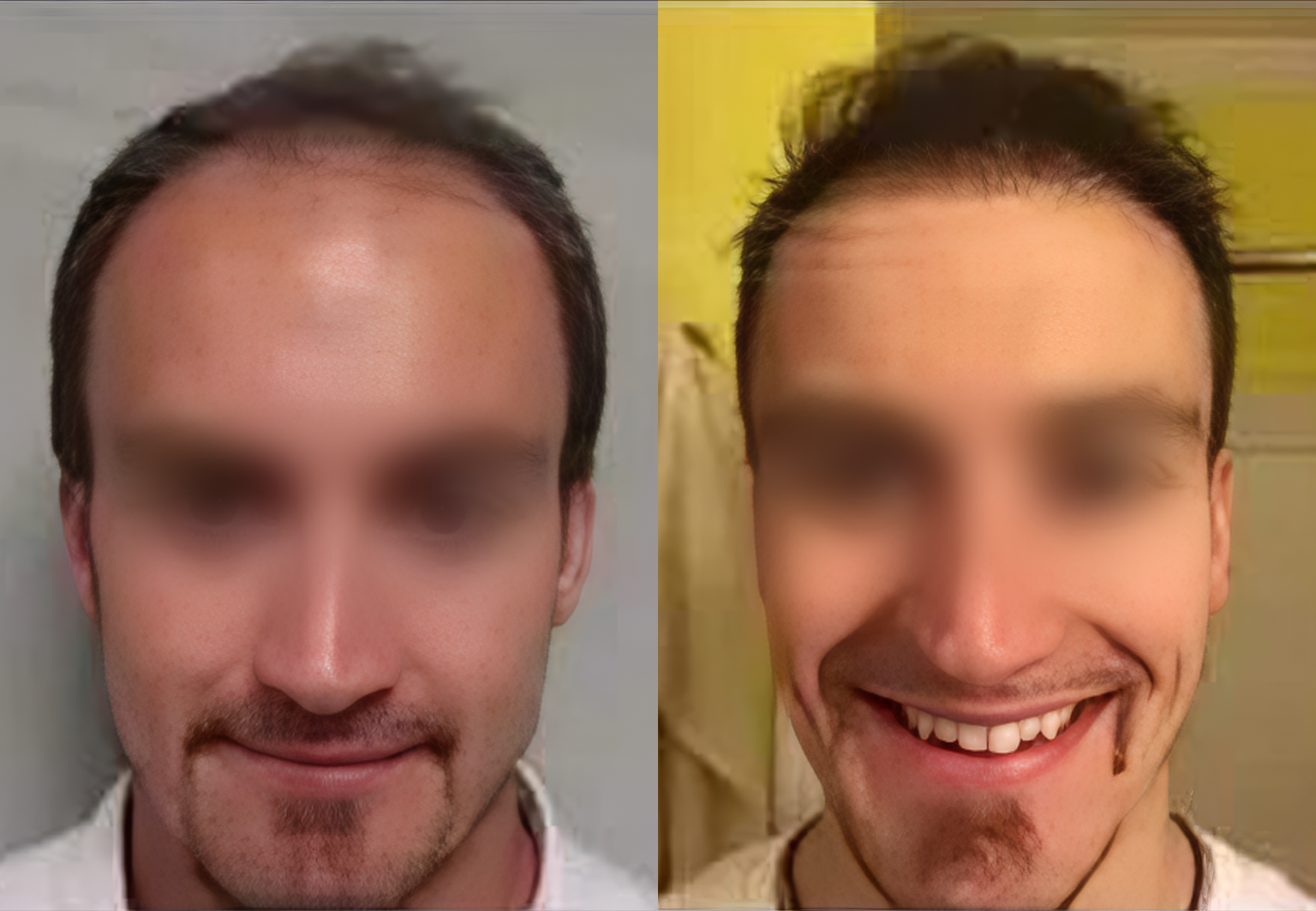 CareBridge - Hair Transplant - Before and after DHI (2)