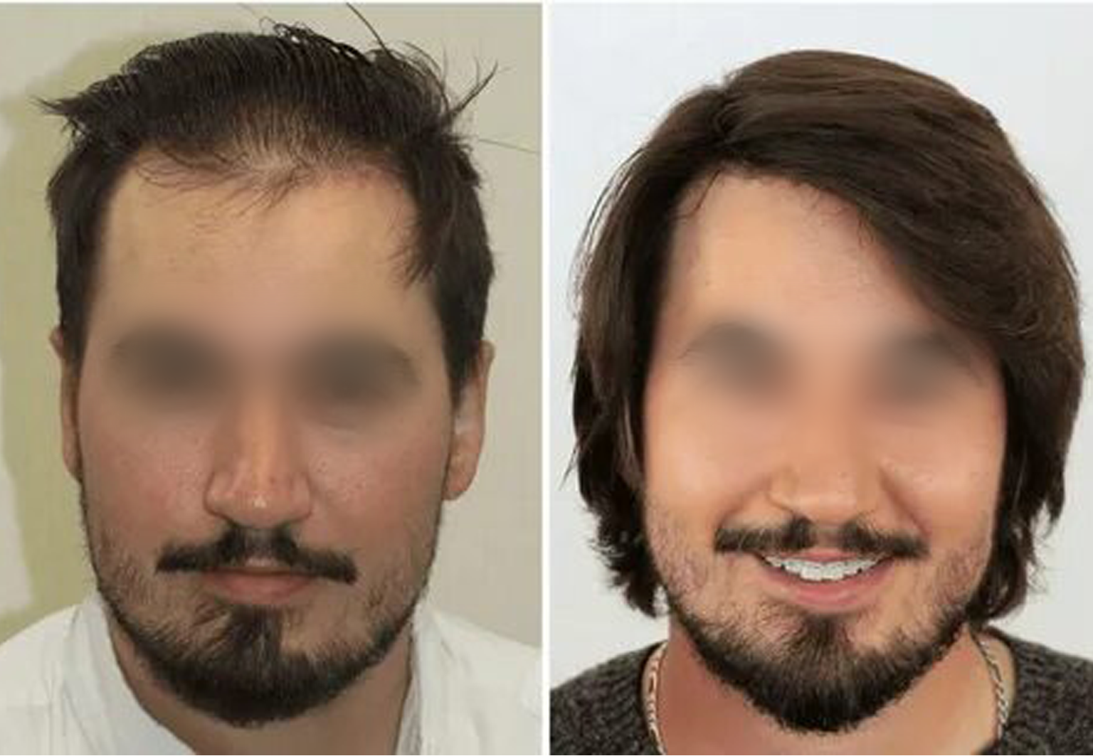 CareBridge - Hair Transplant - Before and after DHI (3)