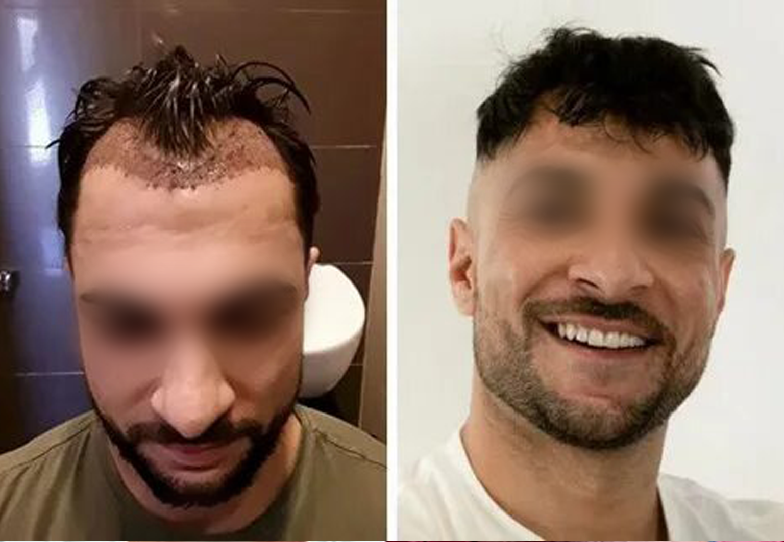 CareBridge - Hair Transplant - Before and after DHI (4)