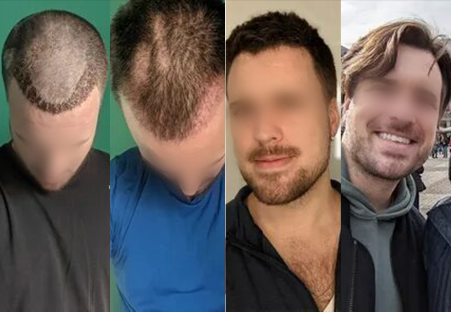 CareBridge - Hair Transplant - Before and after DHI