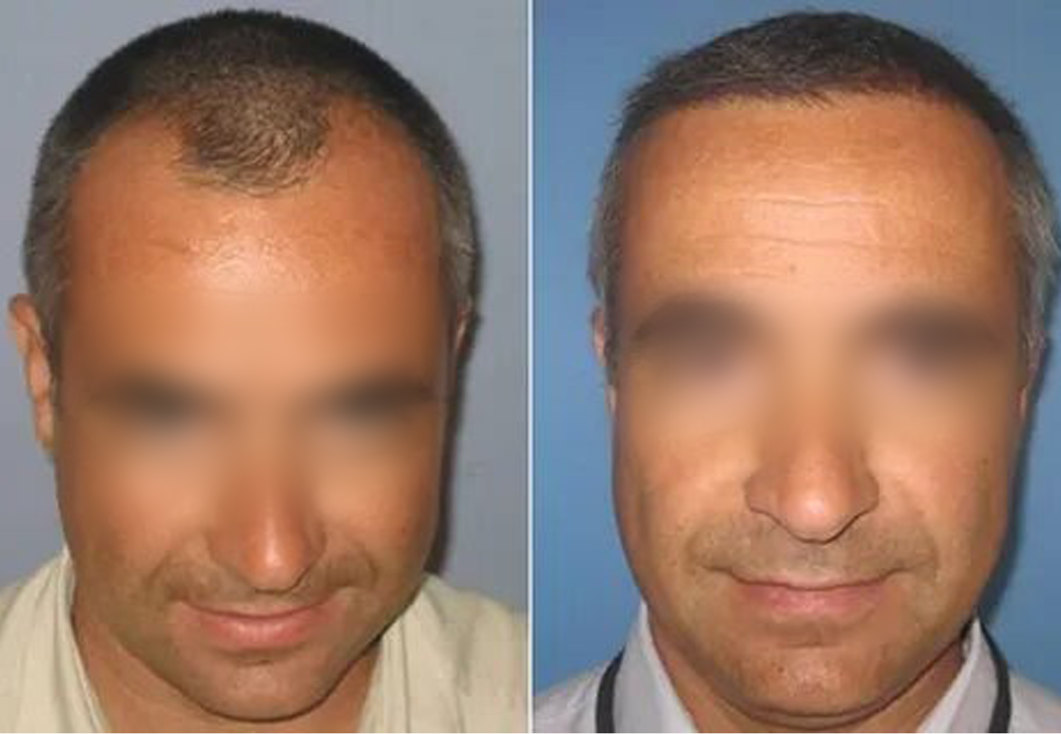 CareBridge - Hair Transplant - Before and after FUE (2)