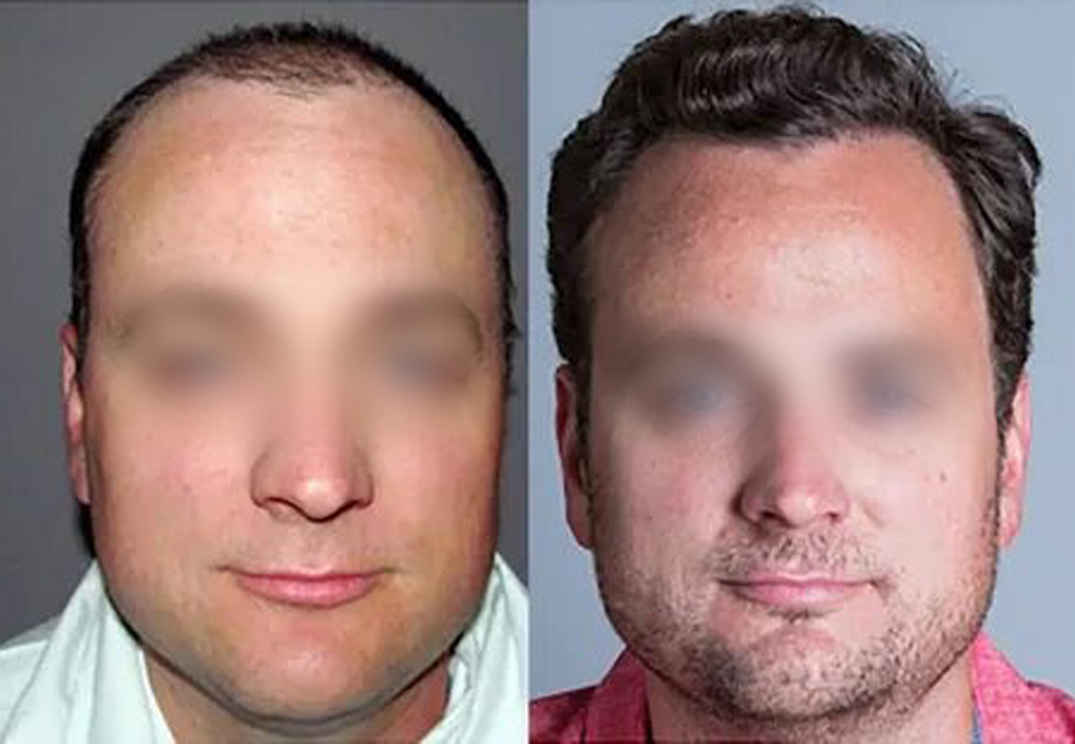 CareBridge - Hair Transplant - Before and after FUE (3)