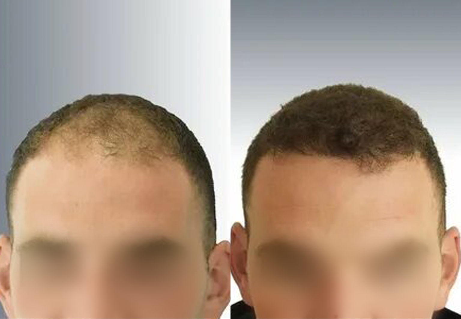 CareBridge - Hair Transplant - Before and after FUE (4)
