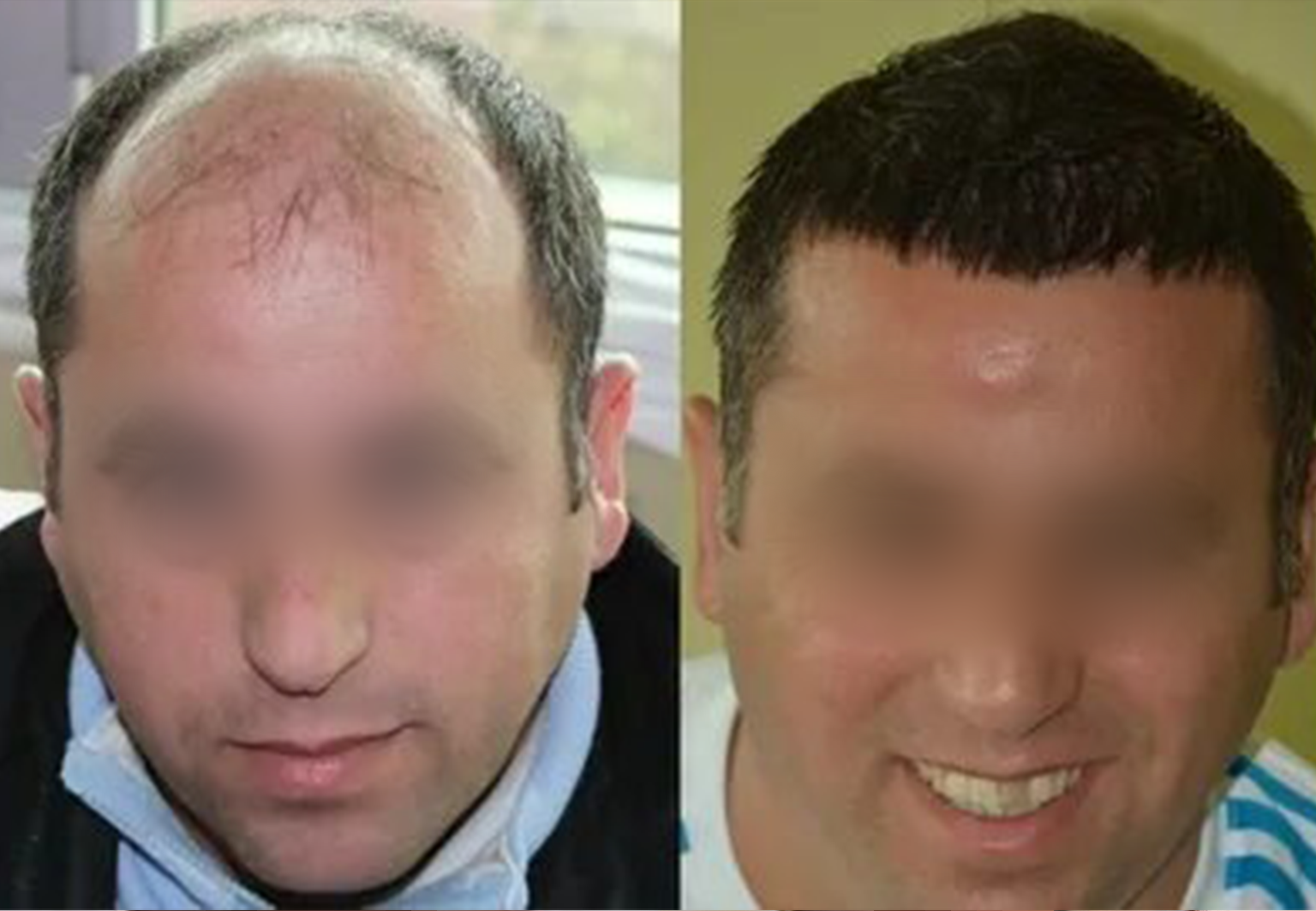 CareBridge - Hair Transplant - Before and after FUE