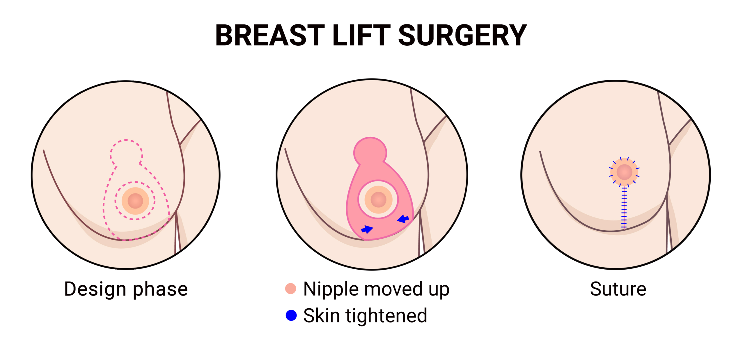 Breast Lift In Turkey With Care Bridge US - The Procedure Breast Lift In Turkey With Care Bridge US - The Procedure