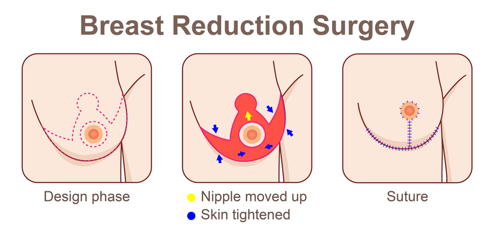 Breast Reduction In Turkey with Care Bridge US - the process Breast Reduction In Turkey with Care Bridge US - the process