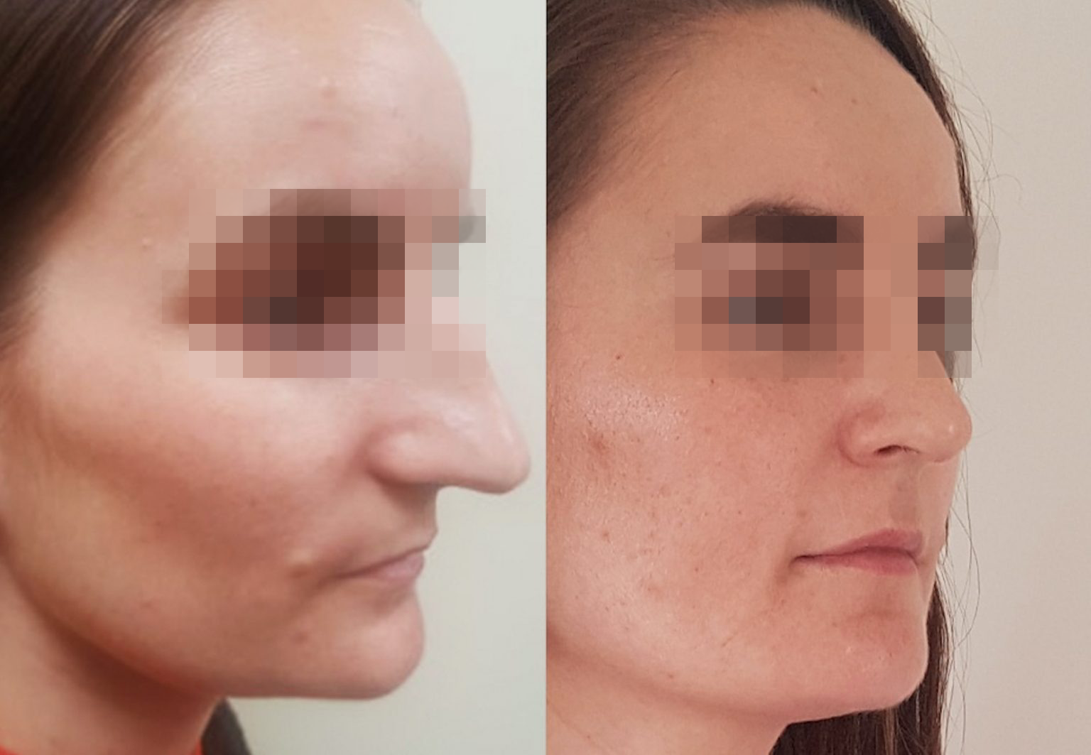 Care Bridge US - Rhinoplasty - Before and After [01]