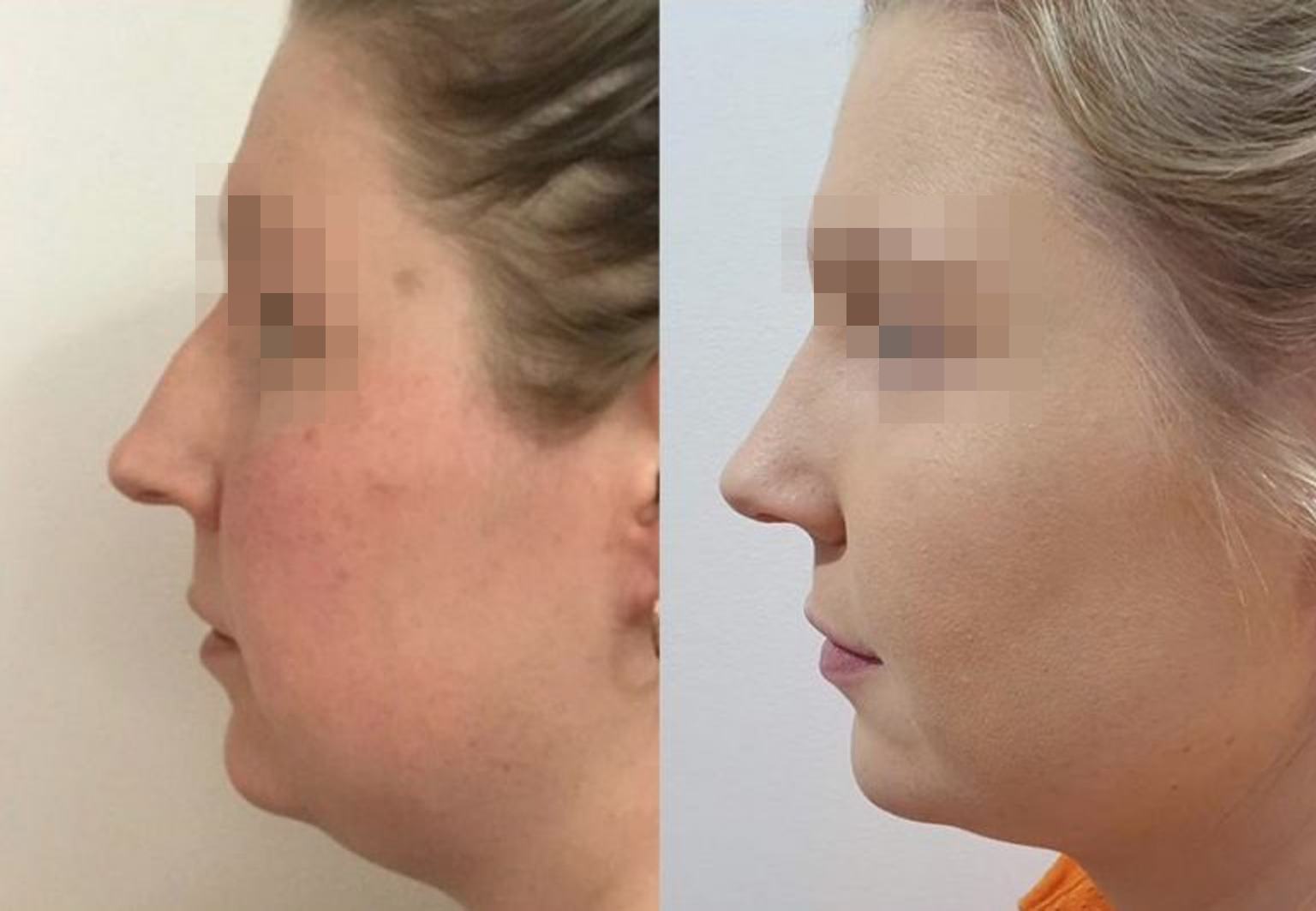 Care Bridge US - Rhinoplasty - Before and After [02]