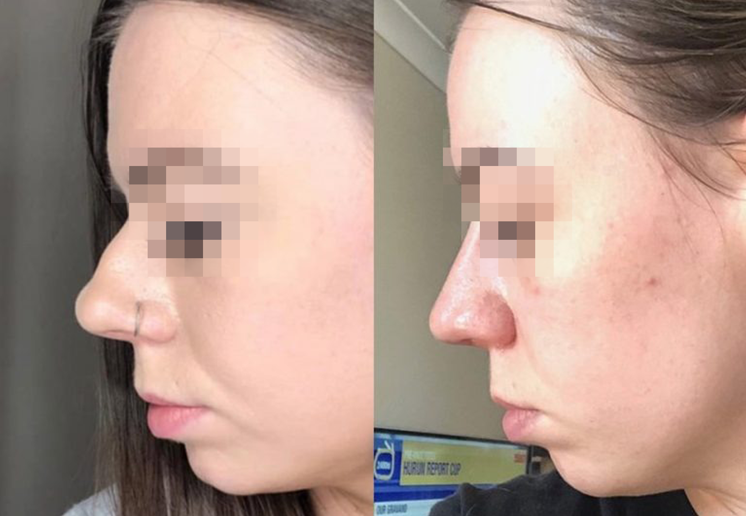 Care Bridge US - Rhinoplasty - Before and After [03]