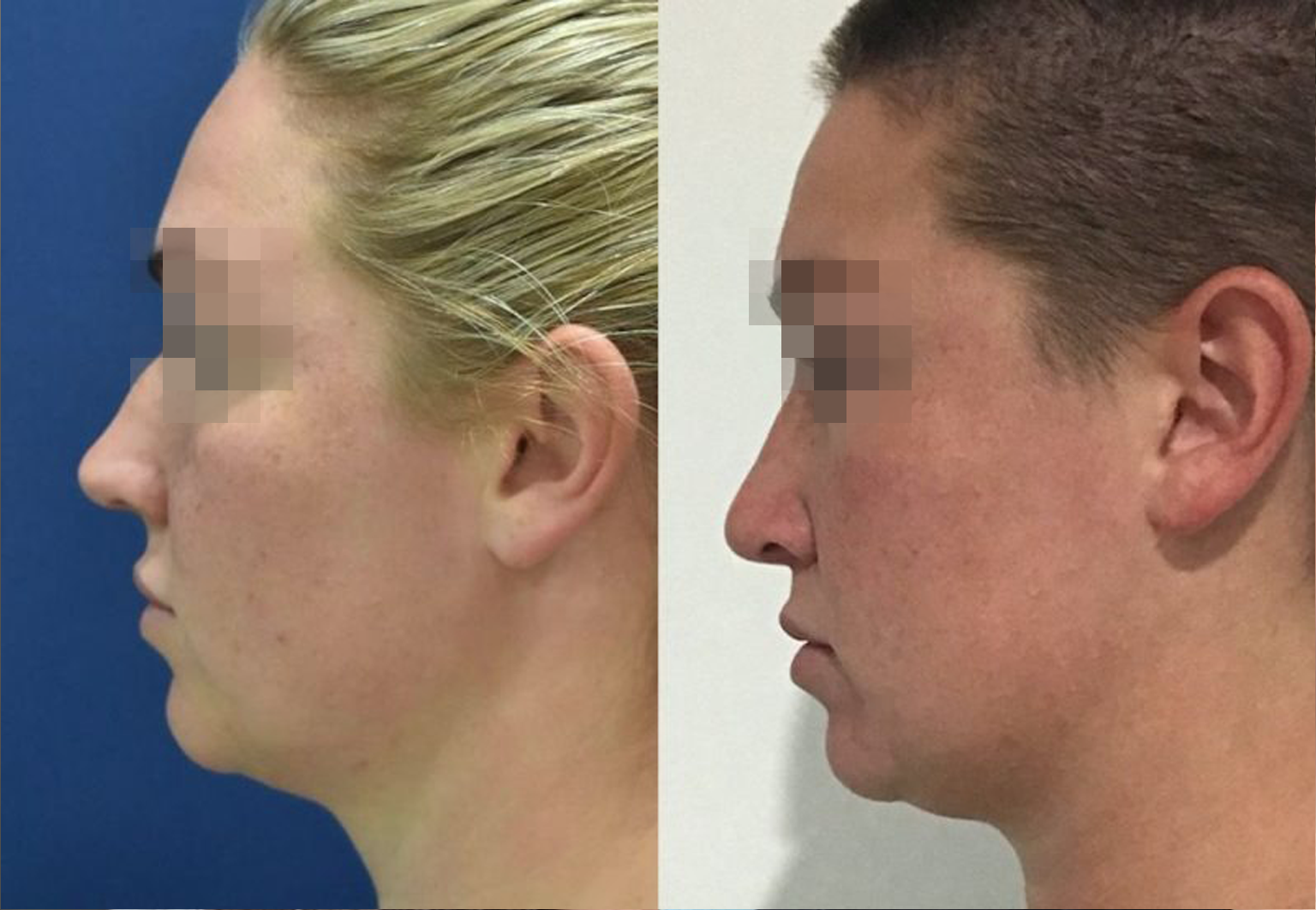 Care Bridge US - Rhinoplasty - Before and After [04]