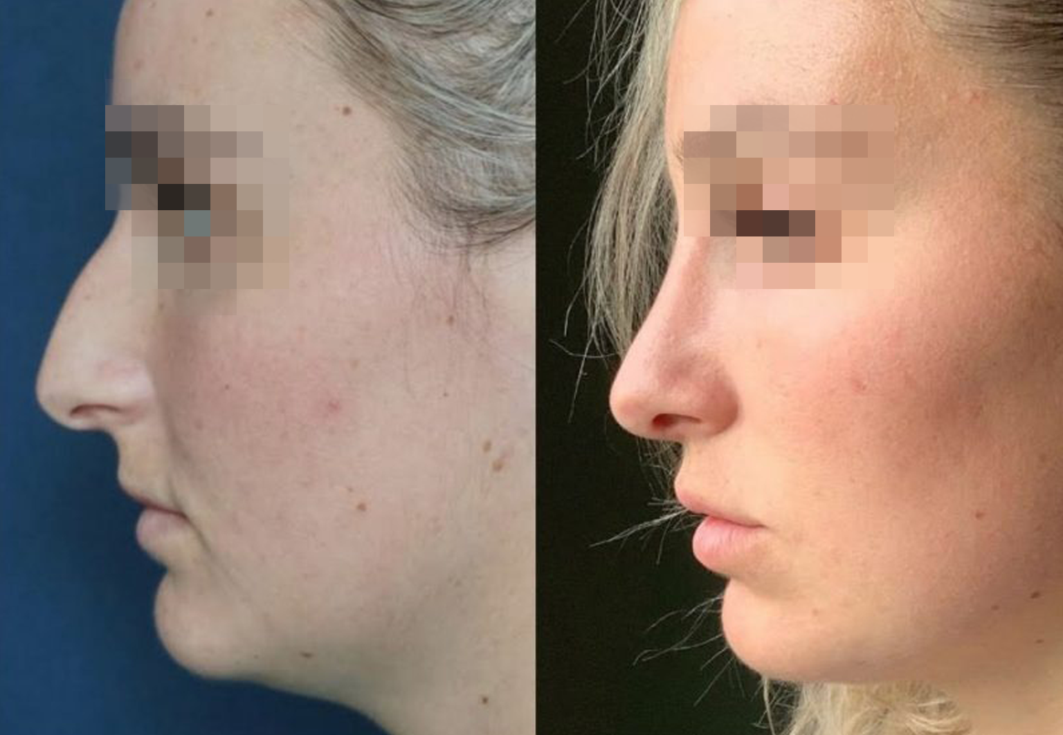 Care Bridge US - Rhinoplasty - Before and After [05]