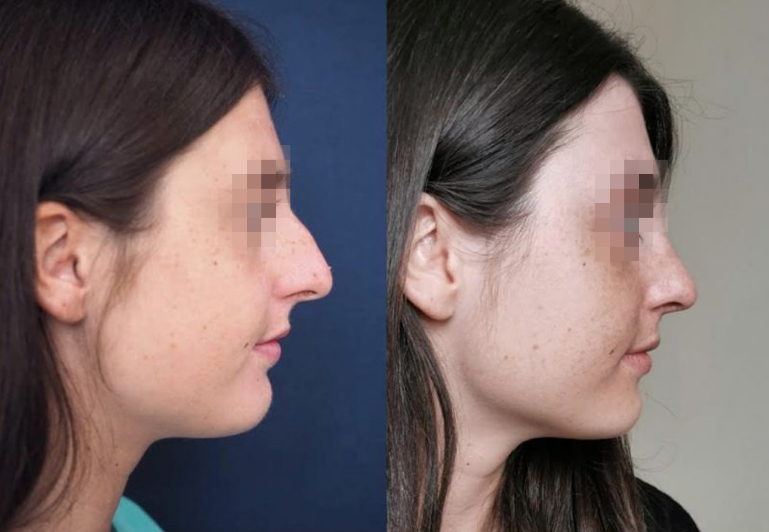 Care Bridge US - Rhinoplasty - Before and After [06]