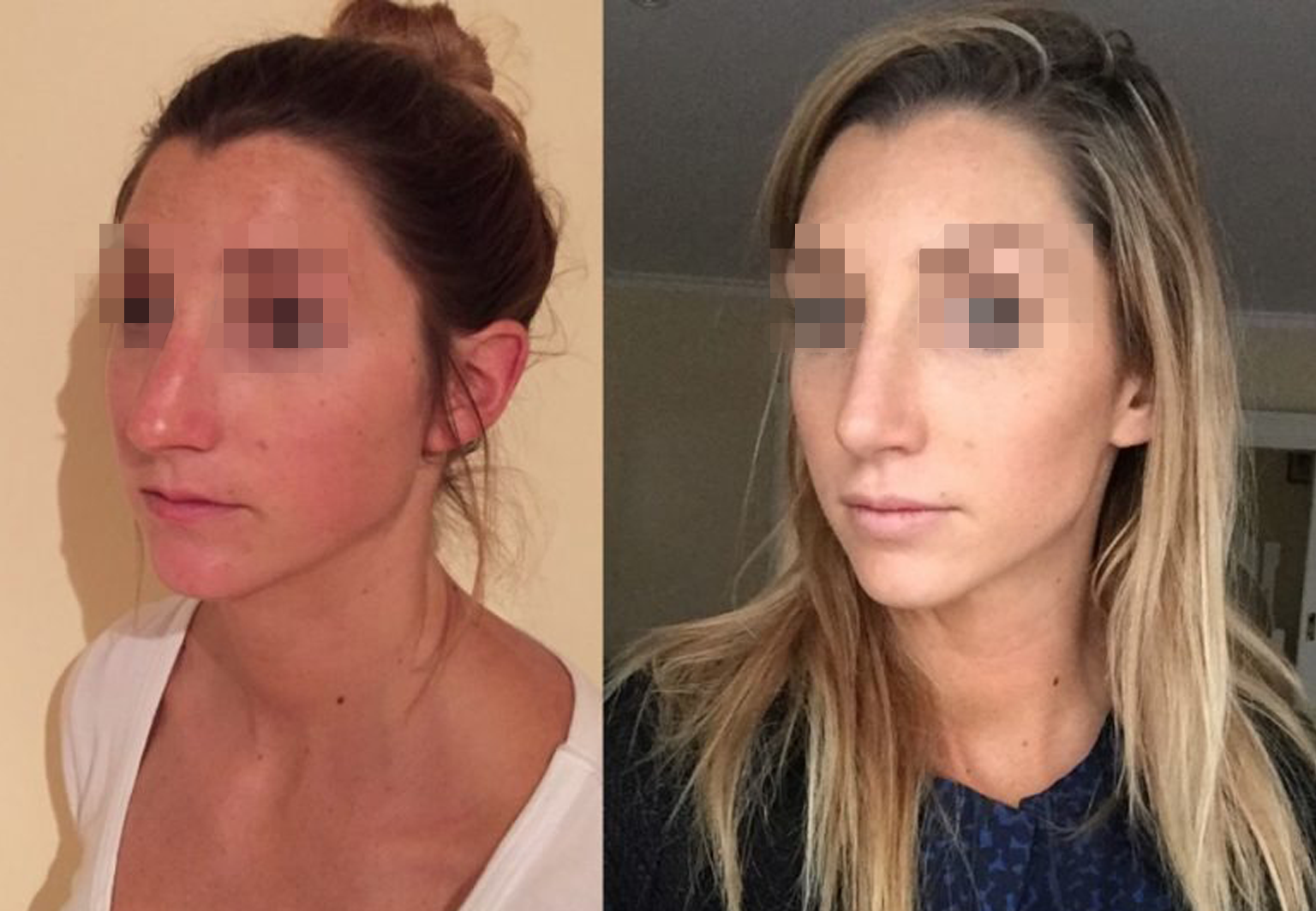 Care Bridge US - Rhinoplasty - Before and After [07]