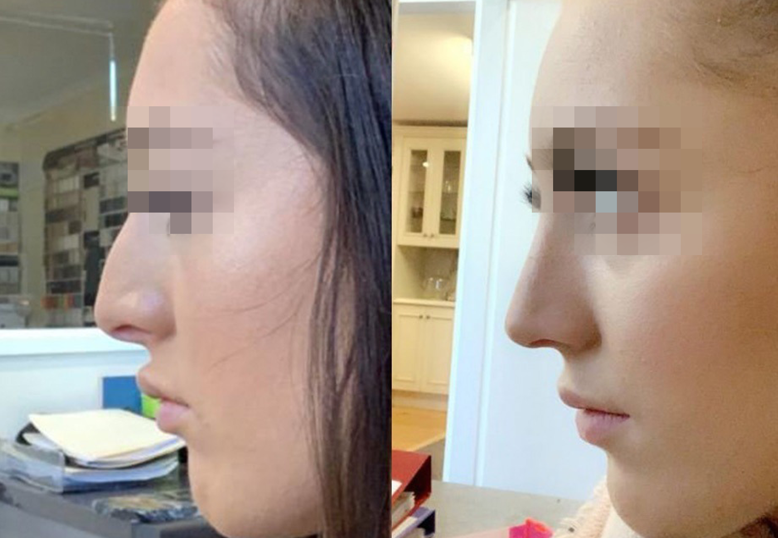 Care Bridge US - Rhinoplasty - Before and After [08]