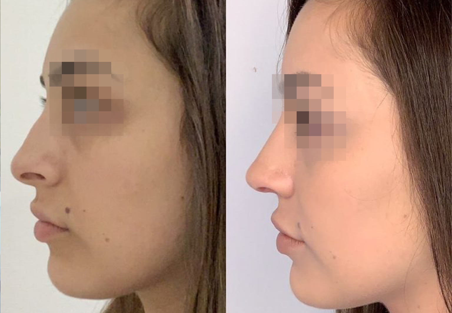 Care Bridge US - Rhinoplasty - Before and After [09]
