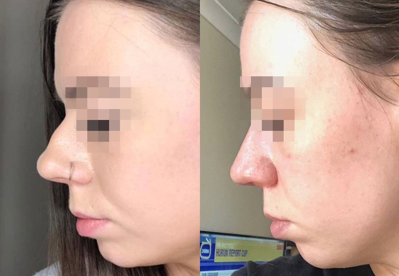 Care Bridge US - Rhinoplasty - Before and After [10]
