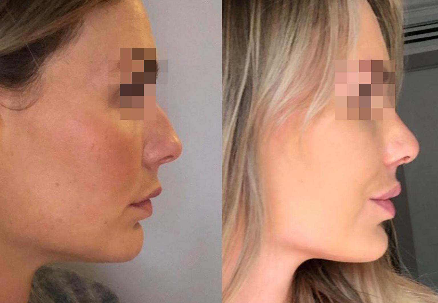 Care Bridge US - Rhinoplasty - Before and After [11]