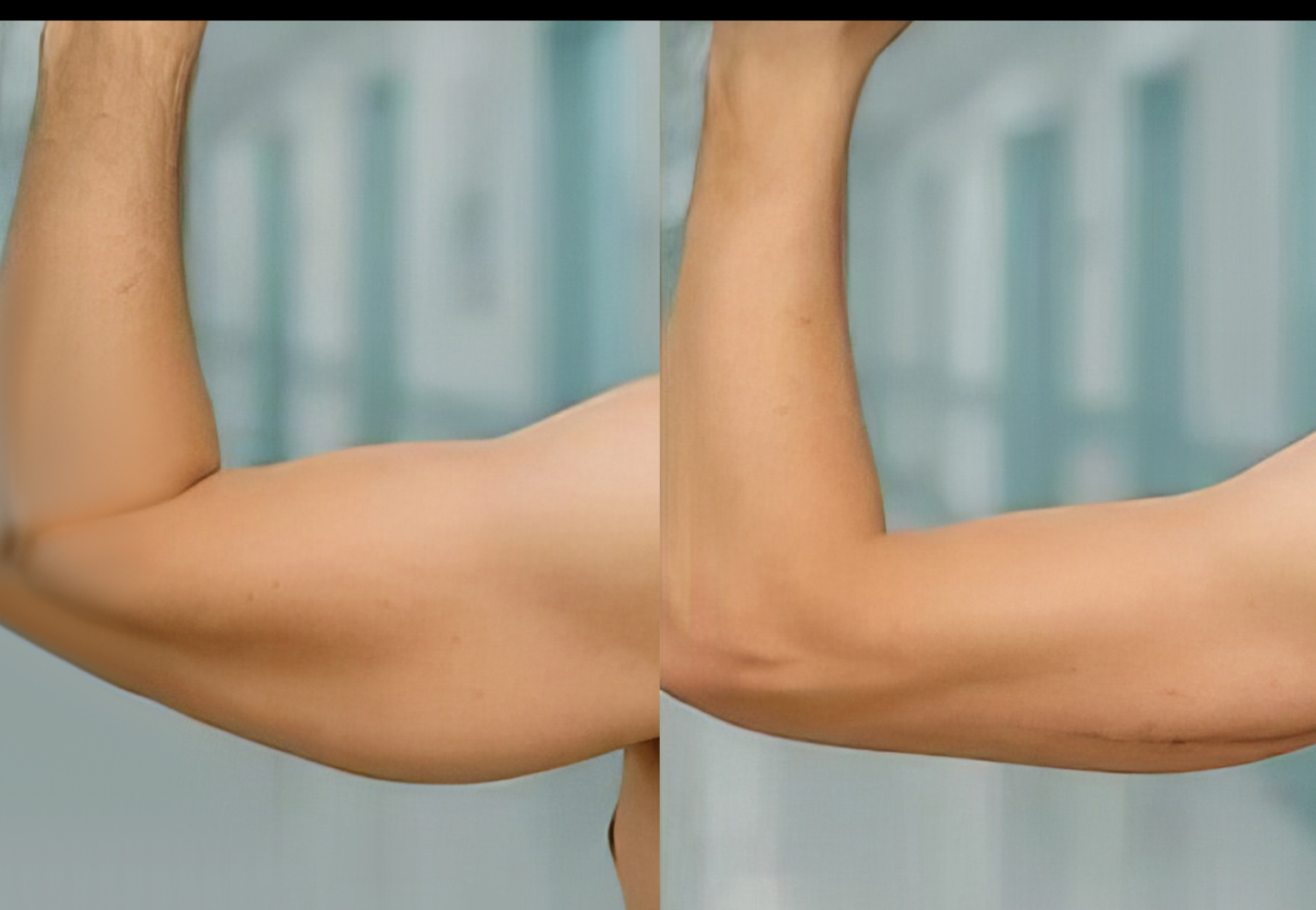 CareBridge - Armlift Surgery - Before and after [01]