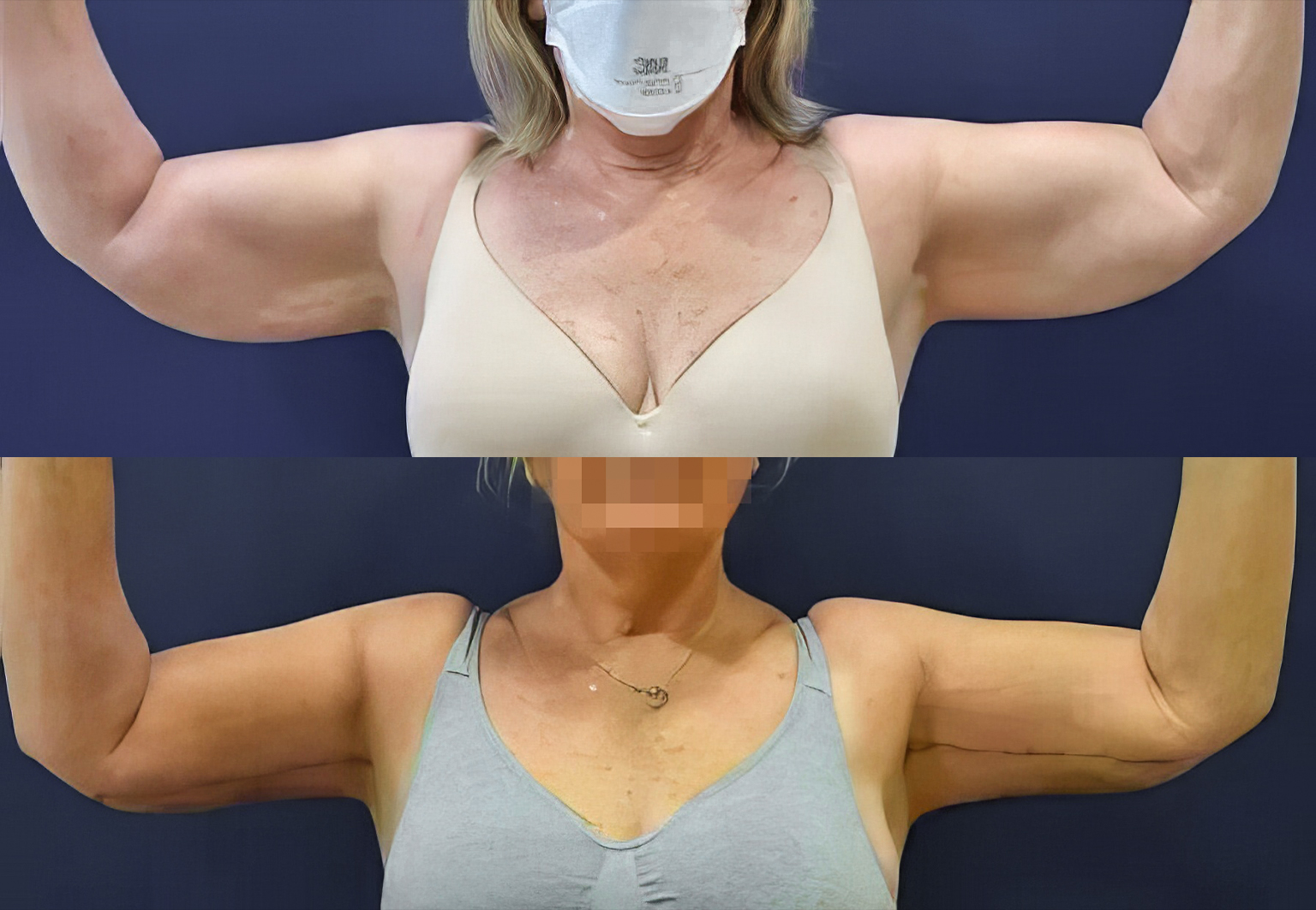 CareBridge - Armlift Surgery - Before and after [02]
