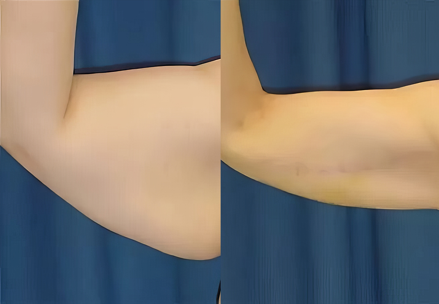 CareBridge - Armlift Surgery - Before and after [04]