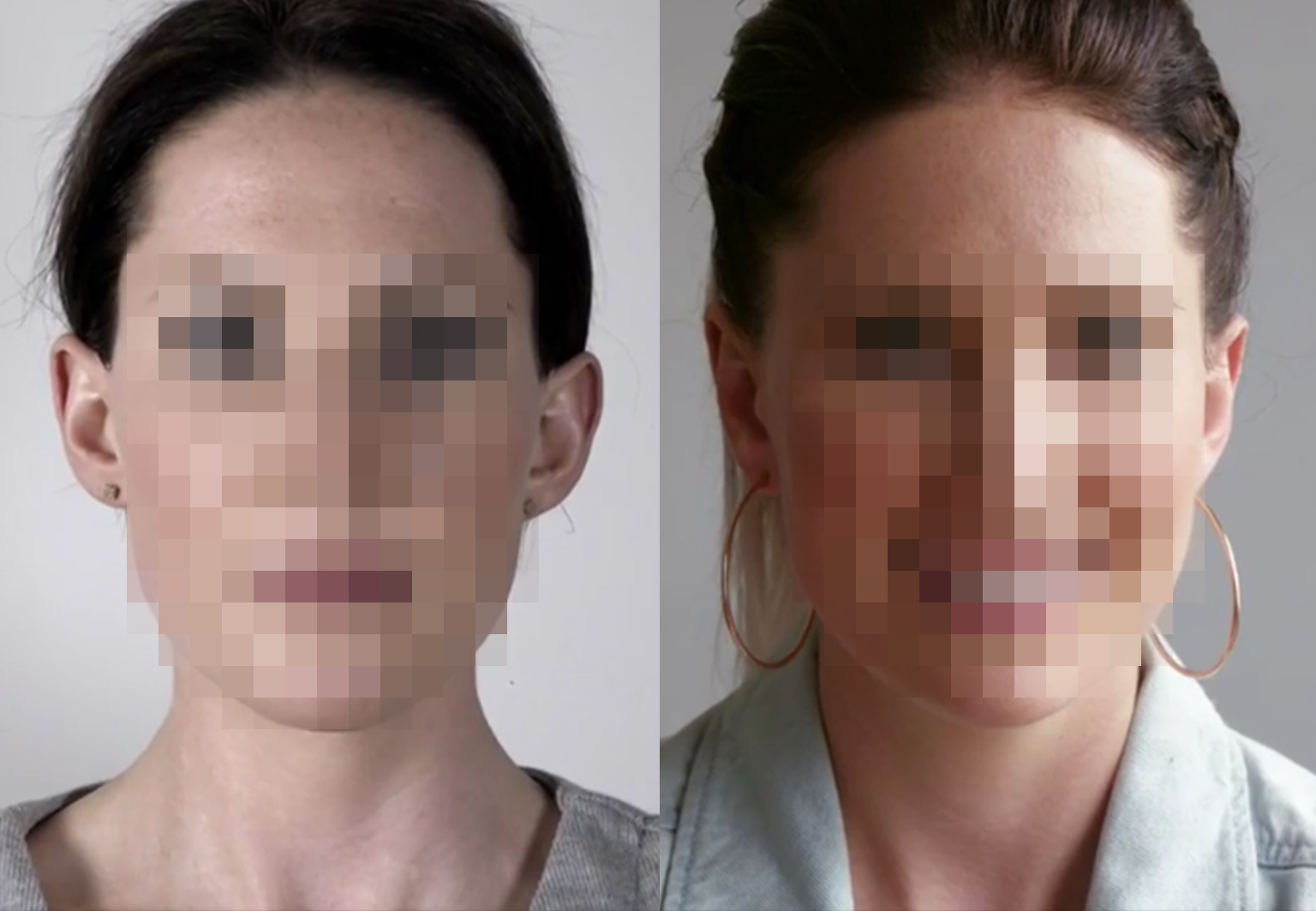 CareBridge - Autoplasty - Before and after [01]