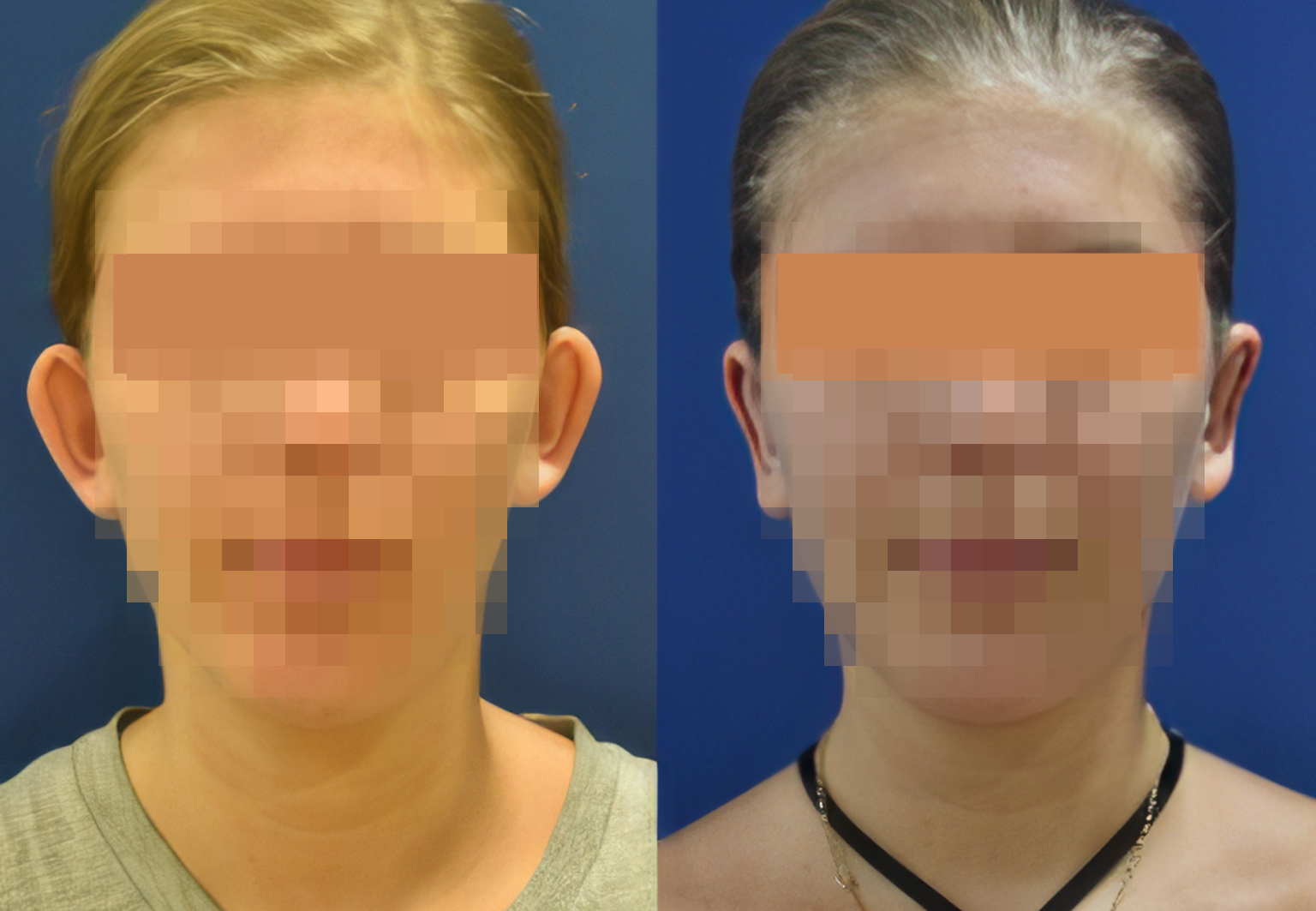 CareBridge - Autoplasty - Before and after [04]