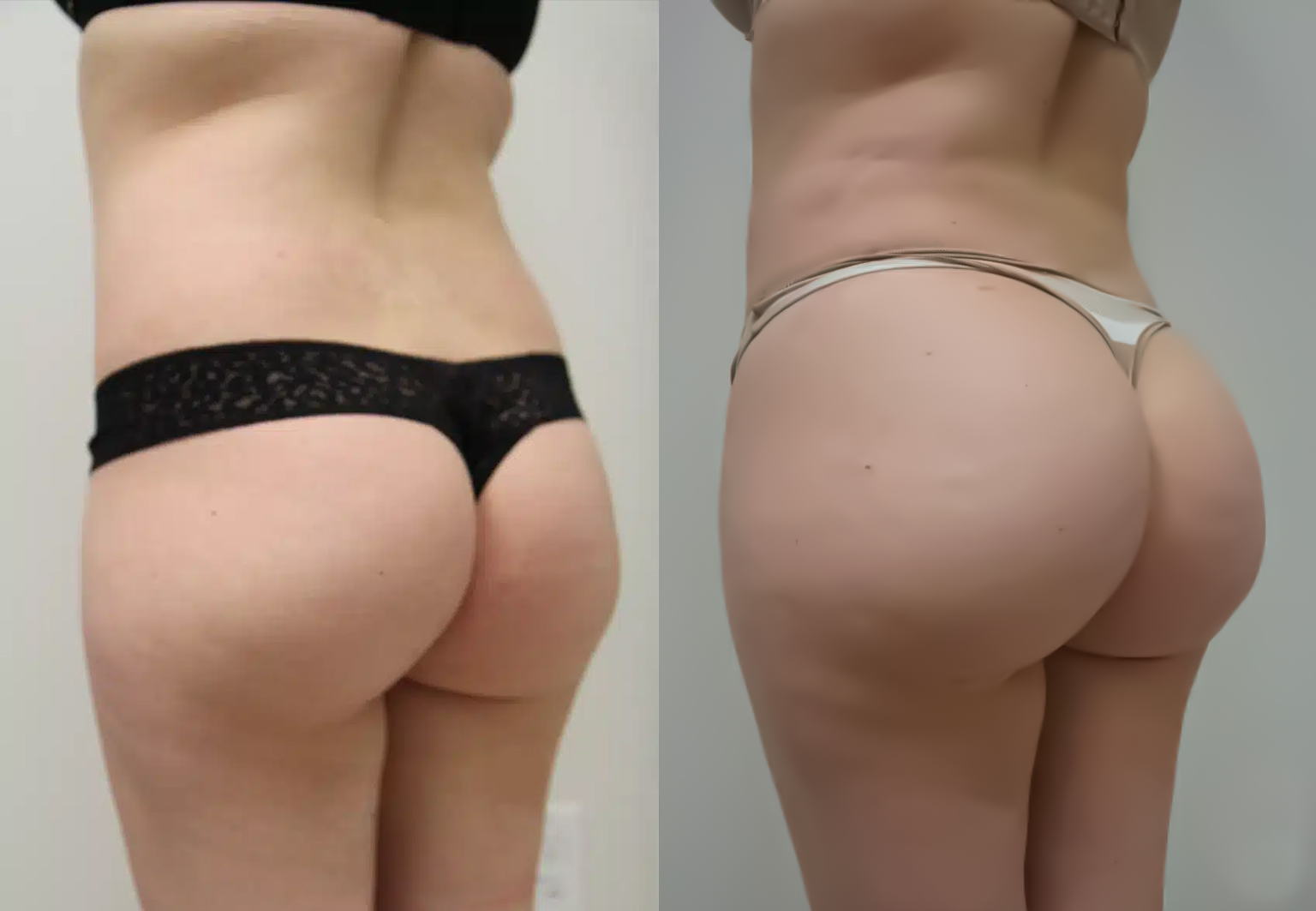 CareBridge - BBL - Before and after [01]