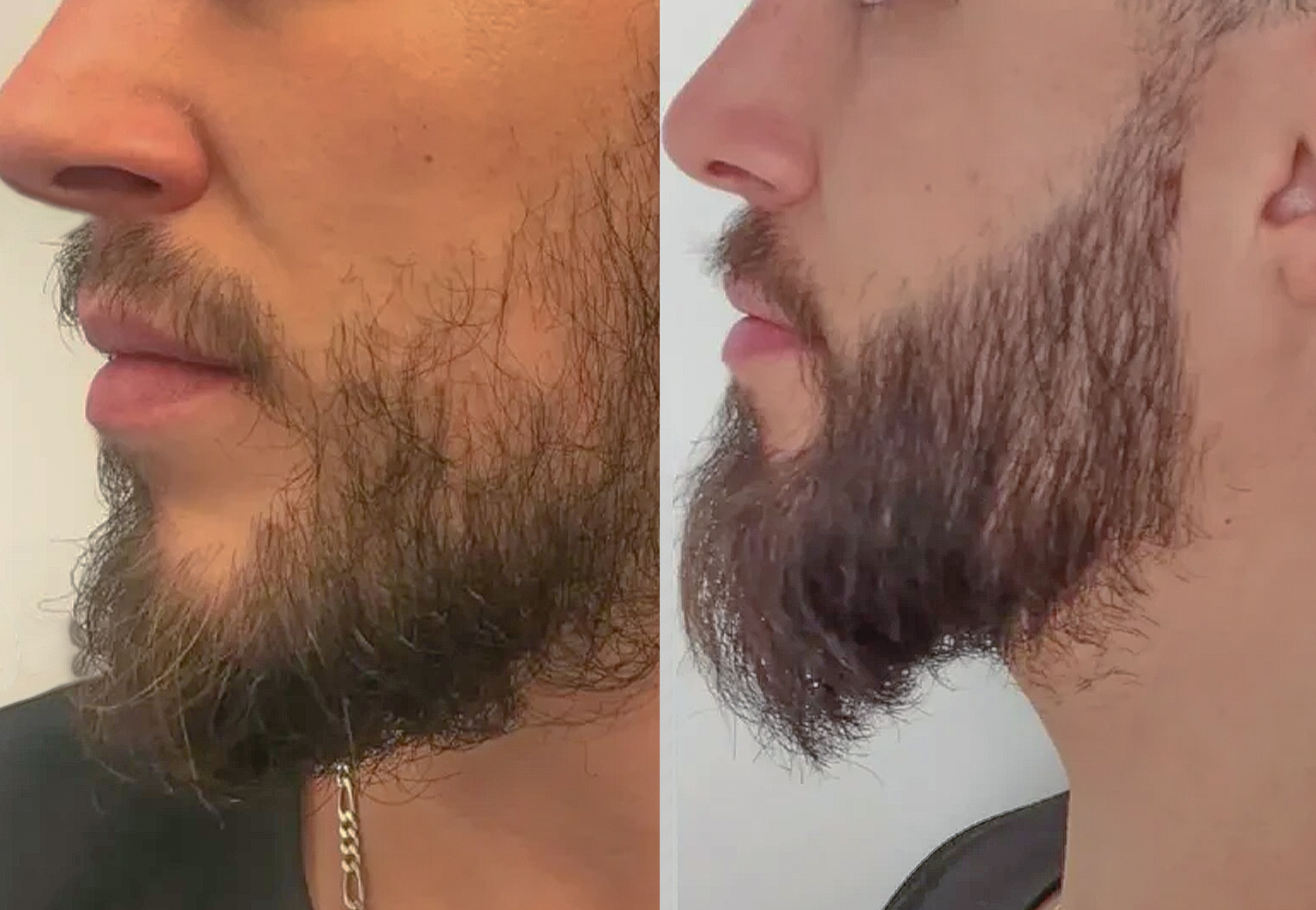 CareBridge - Beard Transplant - Before and after [01]