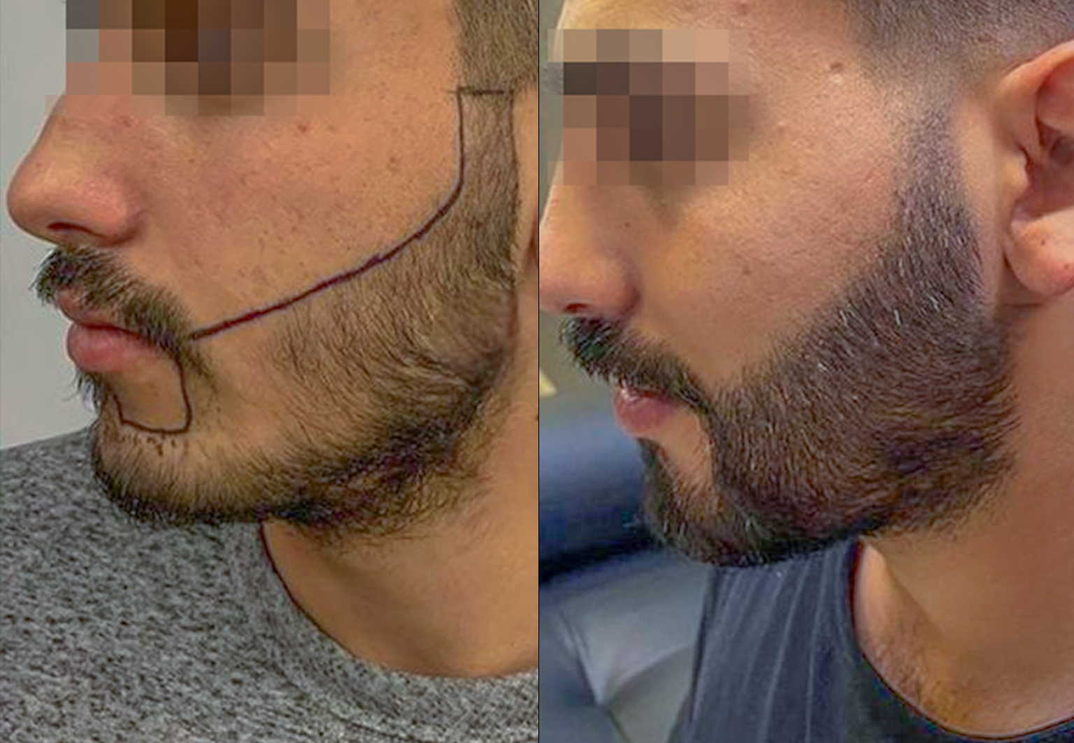 CareBridge - Beard Transplant - Before and after [02]