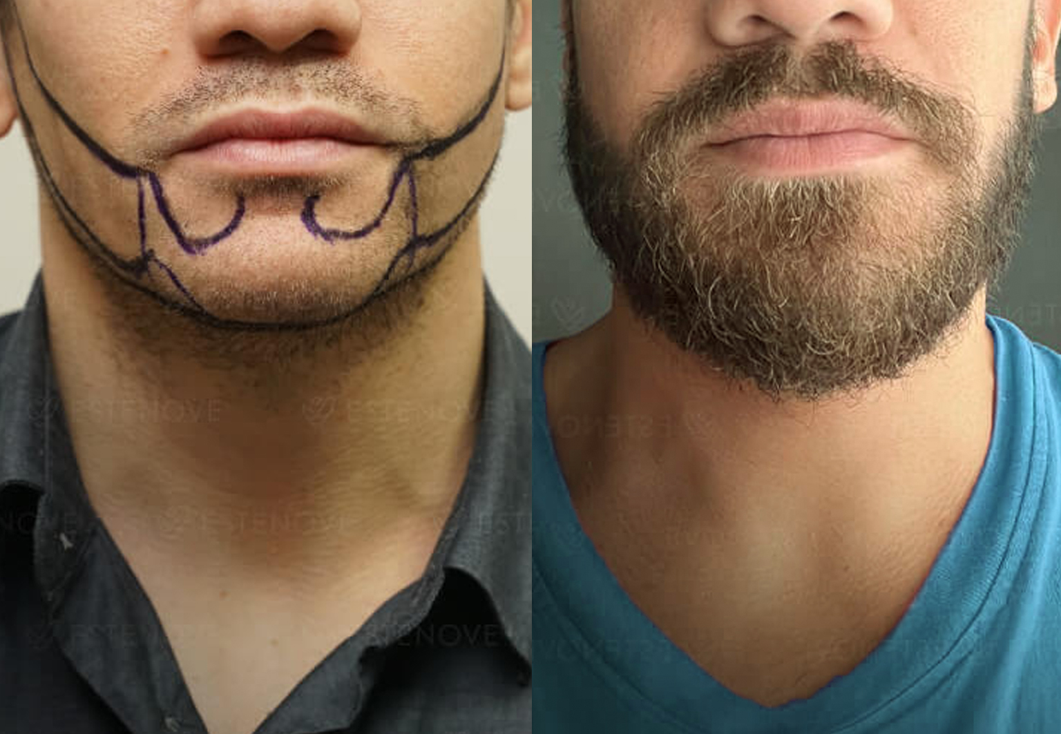 CareBridge - Beard Transplant - Before and after [03]