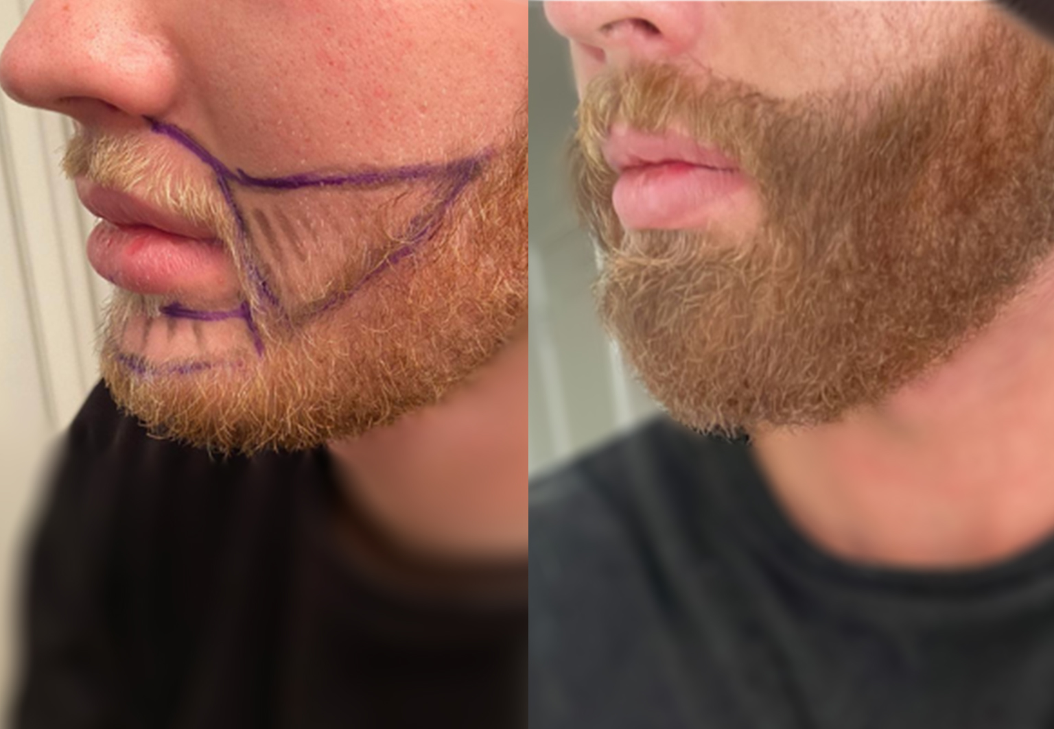 CareBridge - Beard Transplant - Before and after [04]