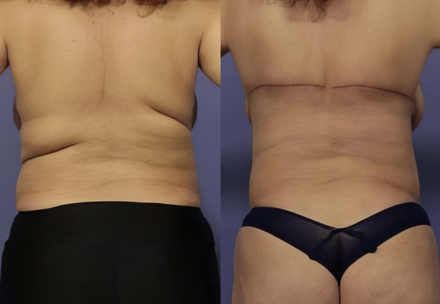 CareBridge - Body Surgery - Before and after [02]