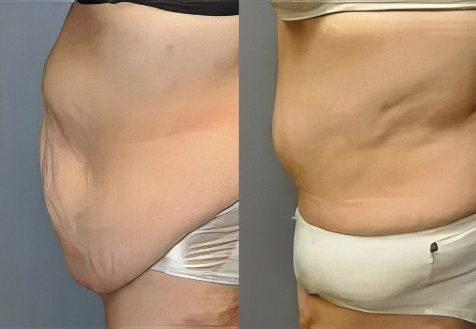 CareBridge - Body Surgery - Before and after [03]