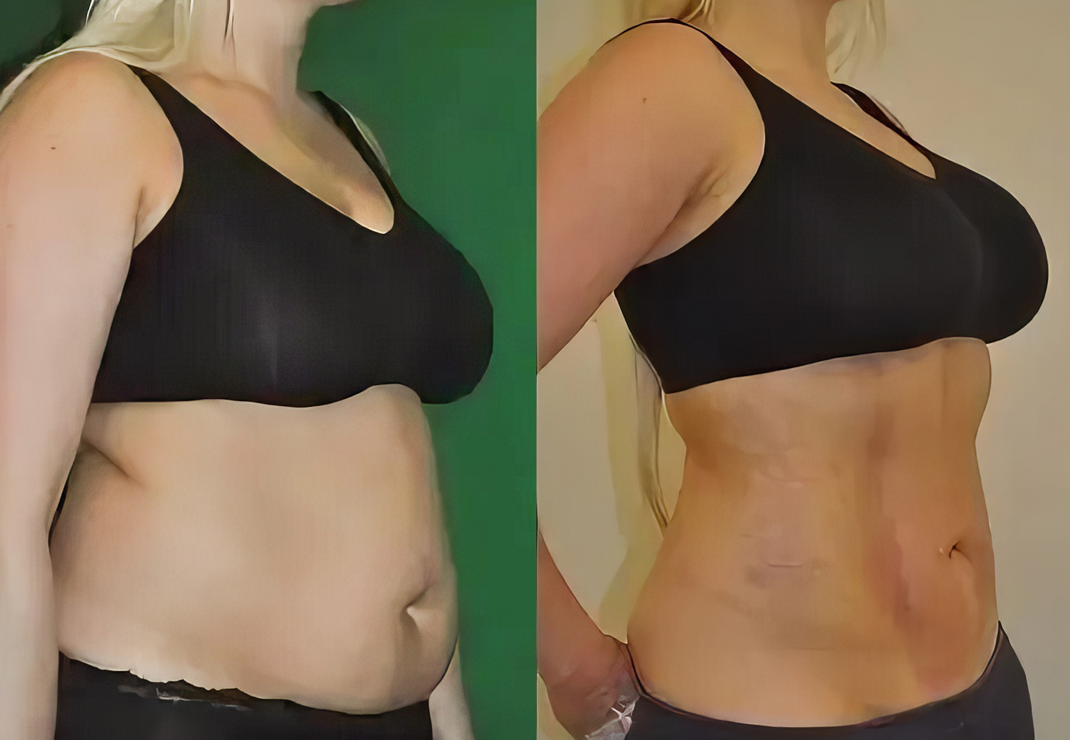 CareBridge - Body Surgery - Before and after [04]