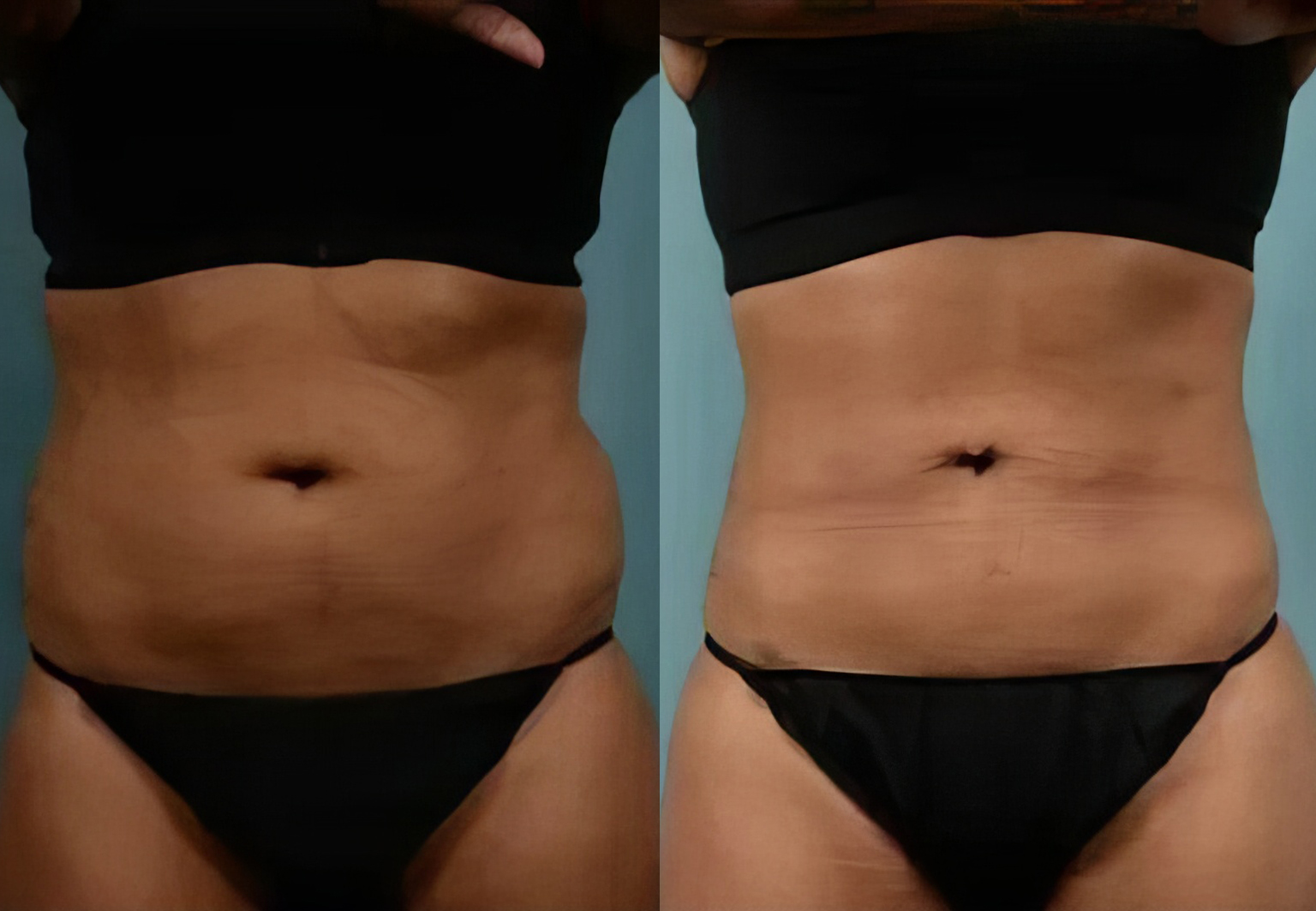 CareBridge - Body Surgery - Before and after [07]