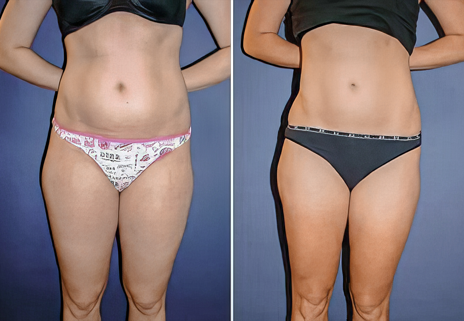 CareBridge - Body Surgery - Before and after [08]
