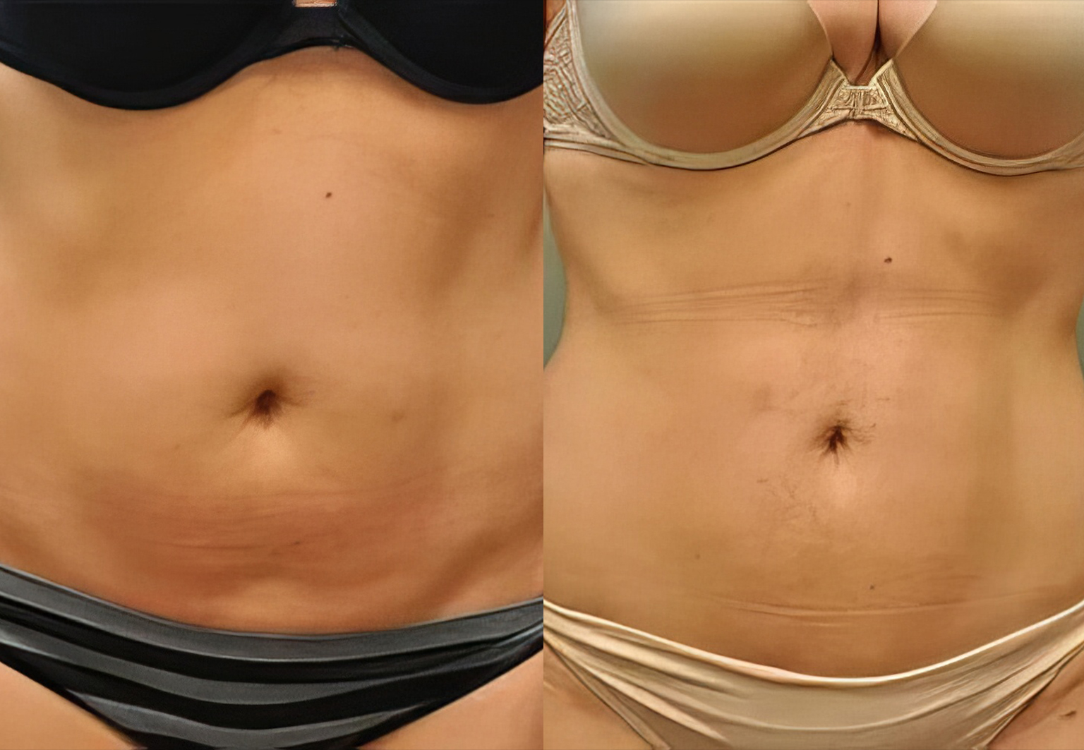 CareBridge - Body Surgery - Before and after [09]