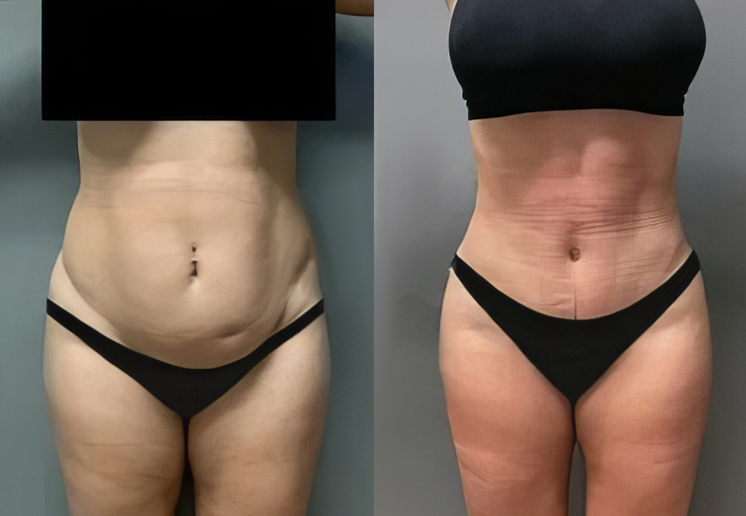 CareBridge - Body Surgery - Before and after [10]