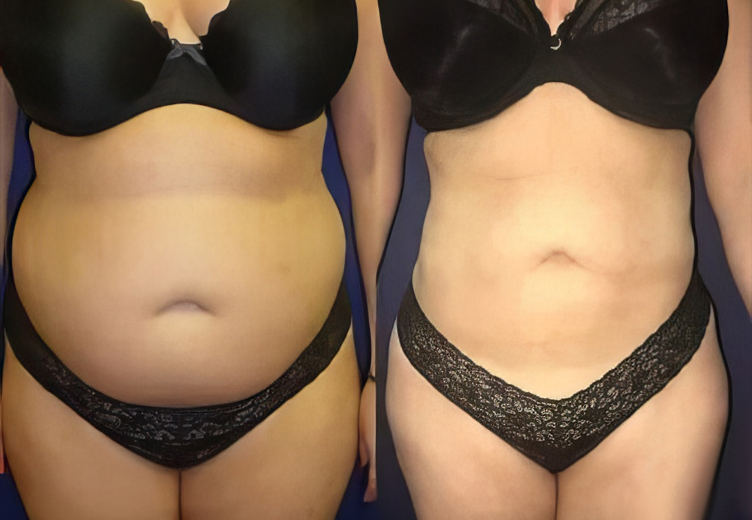 CareBridge - Body Surgery - Before and after [11]