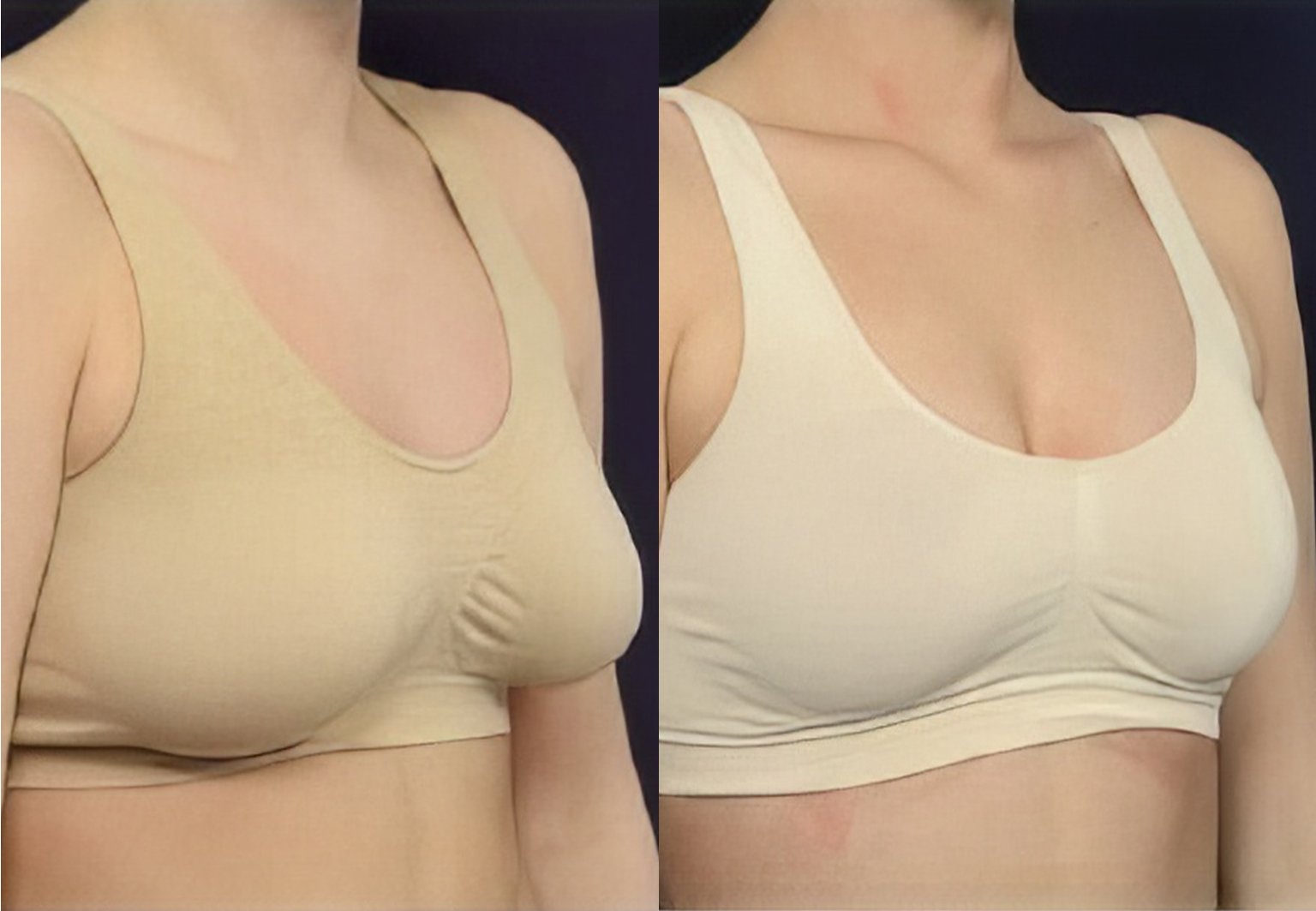 CareBridge - Breast Surgery - Before and after [01]