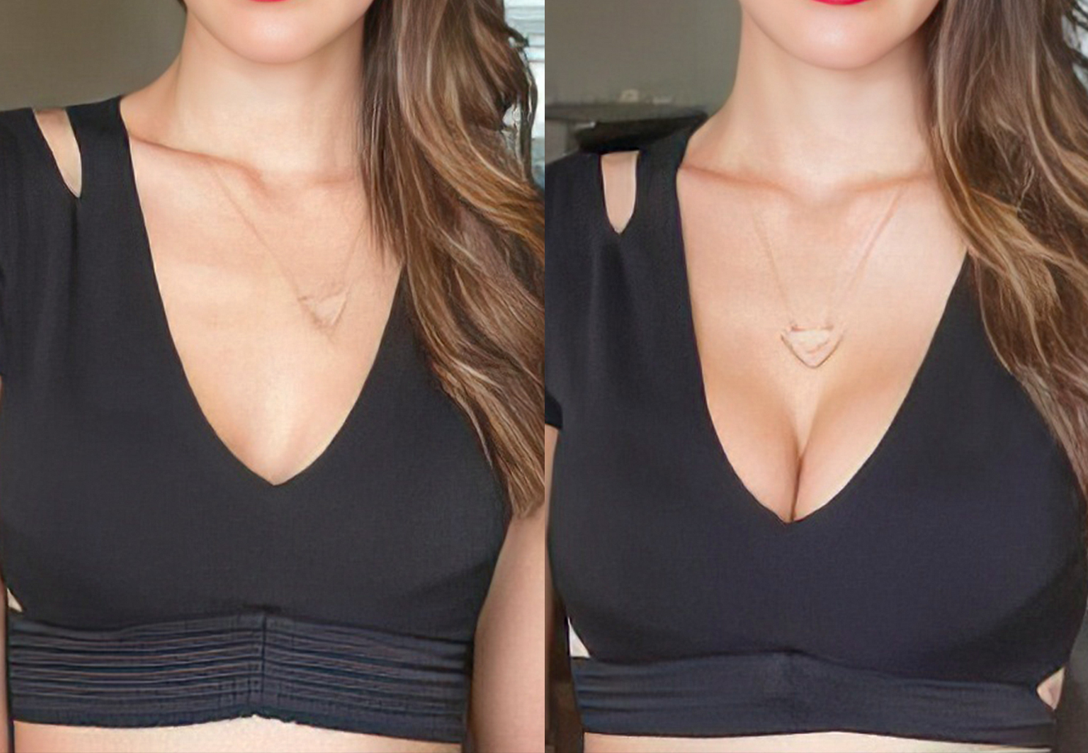 CareBridge - Breast Surgery - Before and after [03]