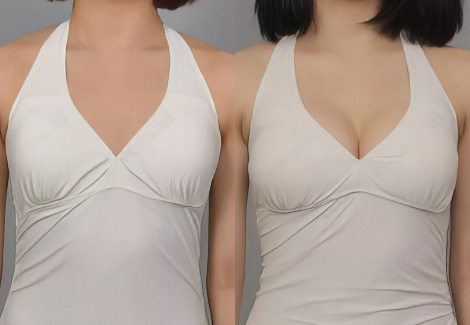 CareBridge - Breast Surgery - Before and after [06]