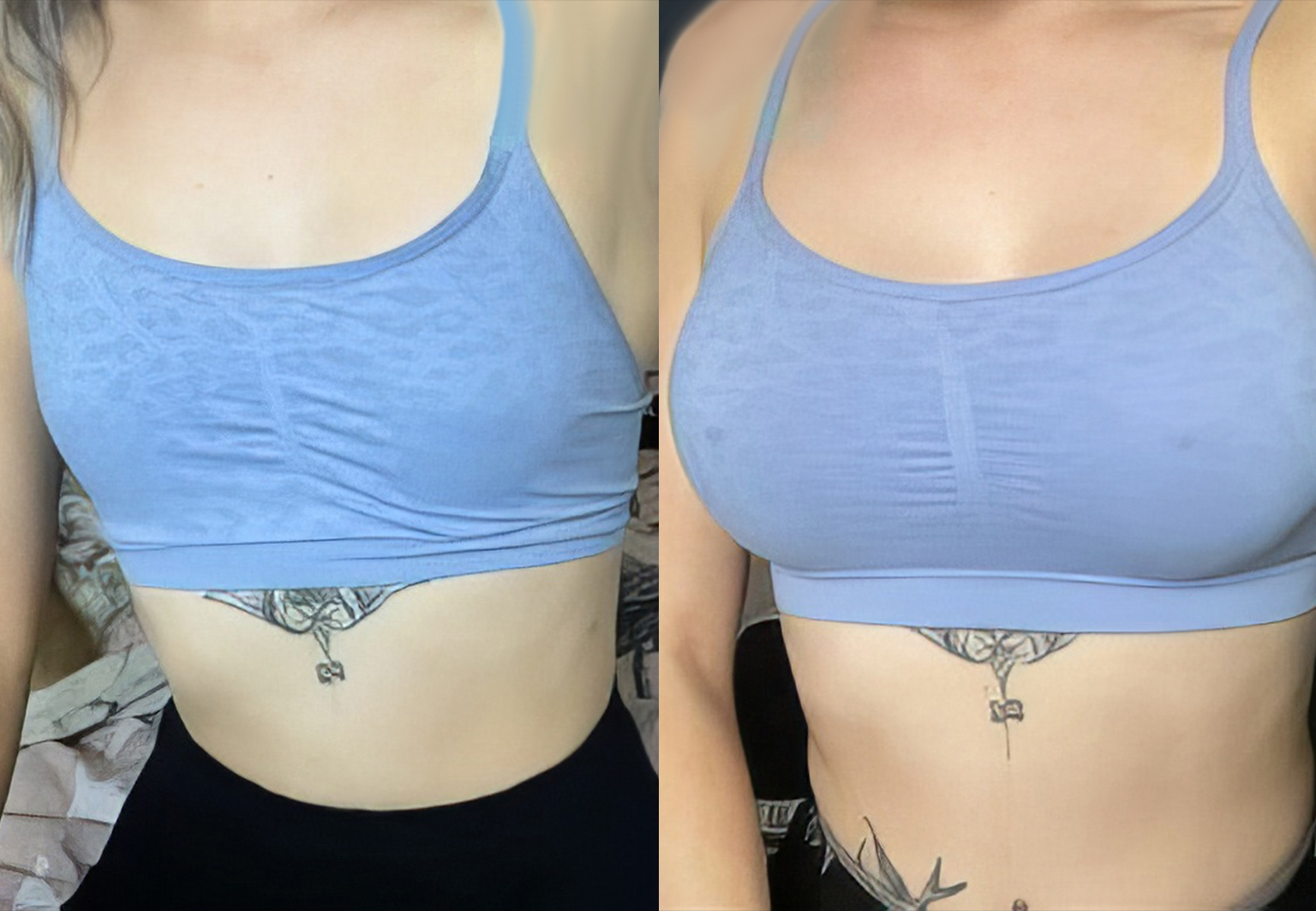 CareBridge - Breast Surgery - Before and after [07]