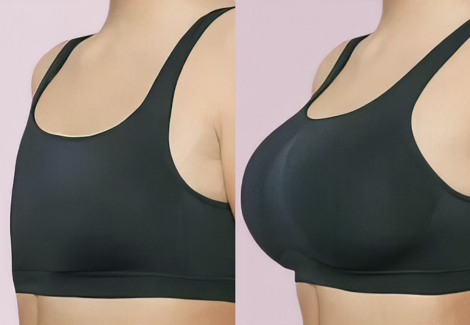 CareBridge - Breast Surgery - Before and after [09]