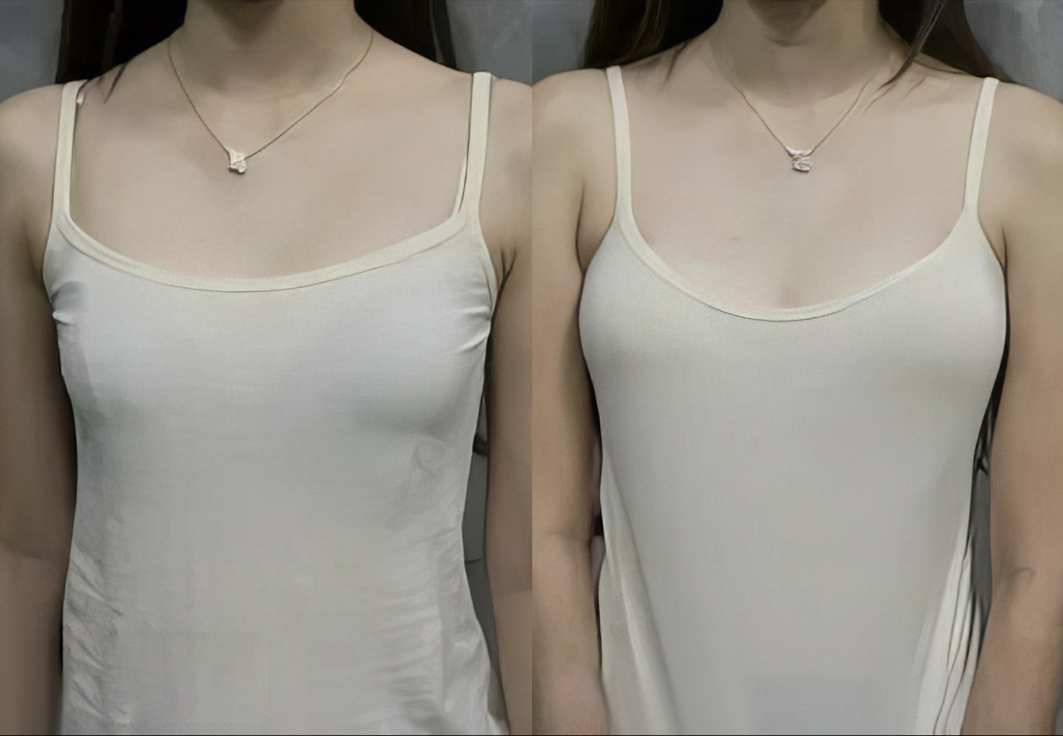 CareBridge - Breast Surgery - Before and after [11]
