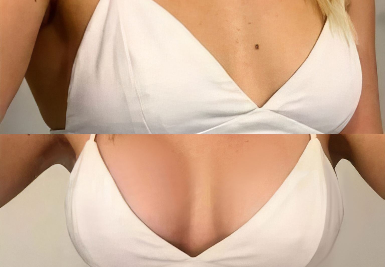 CareBridge - Breast Surgery - Before and after [13]