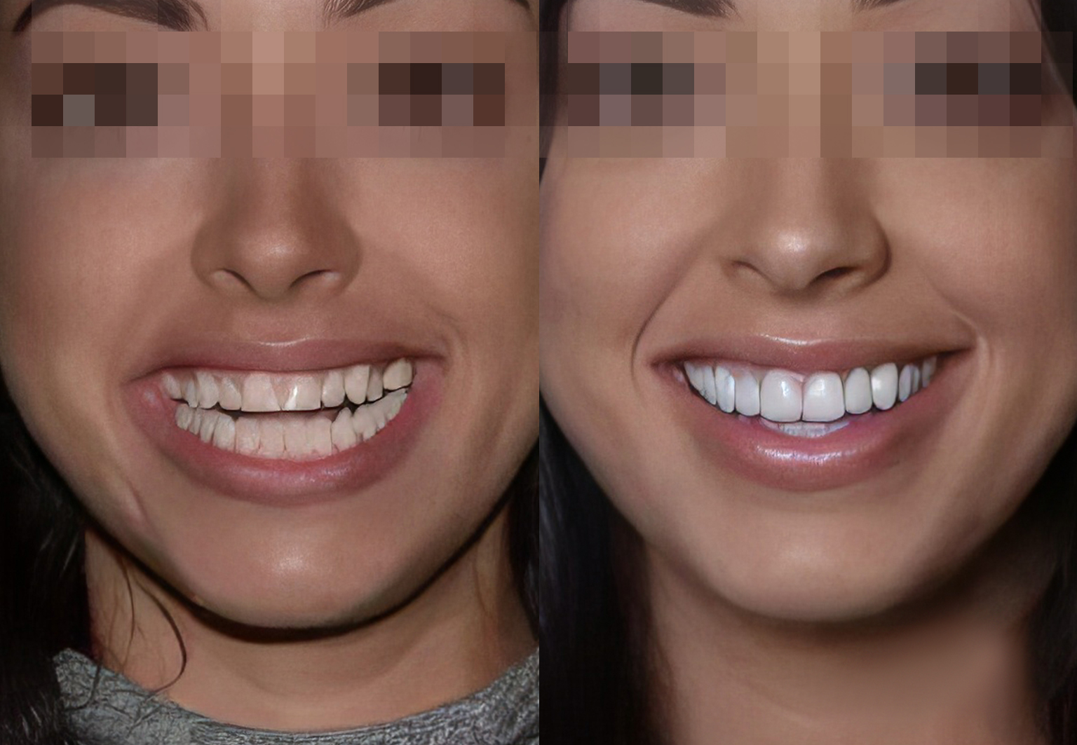 CareBridge - Cosmetic Dentistry - Before and after [04]