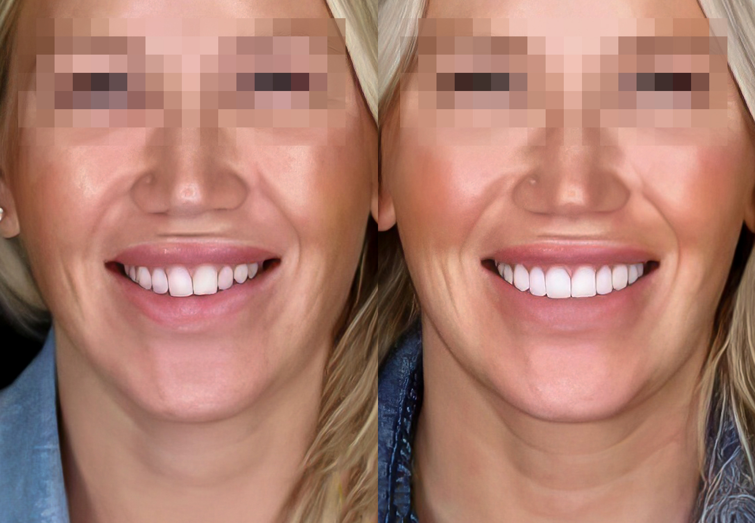 CareBridge - Cosmetic Dentistry - Before and after [05]