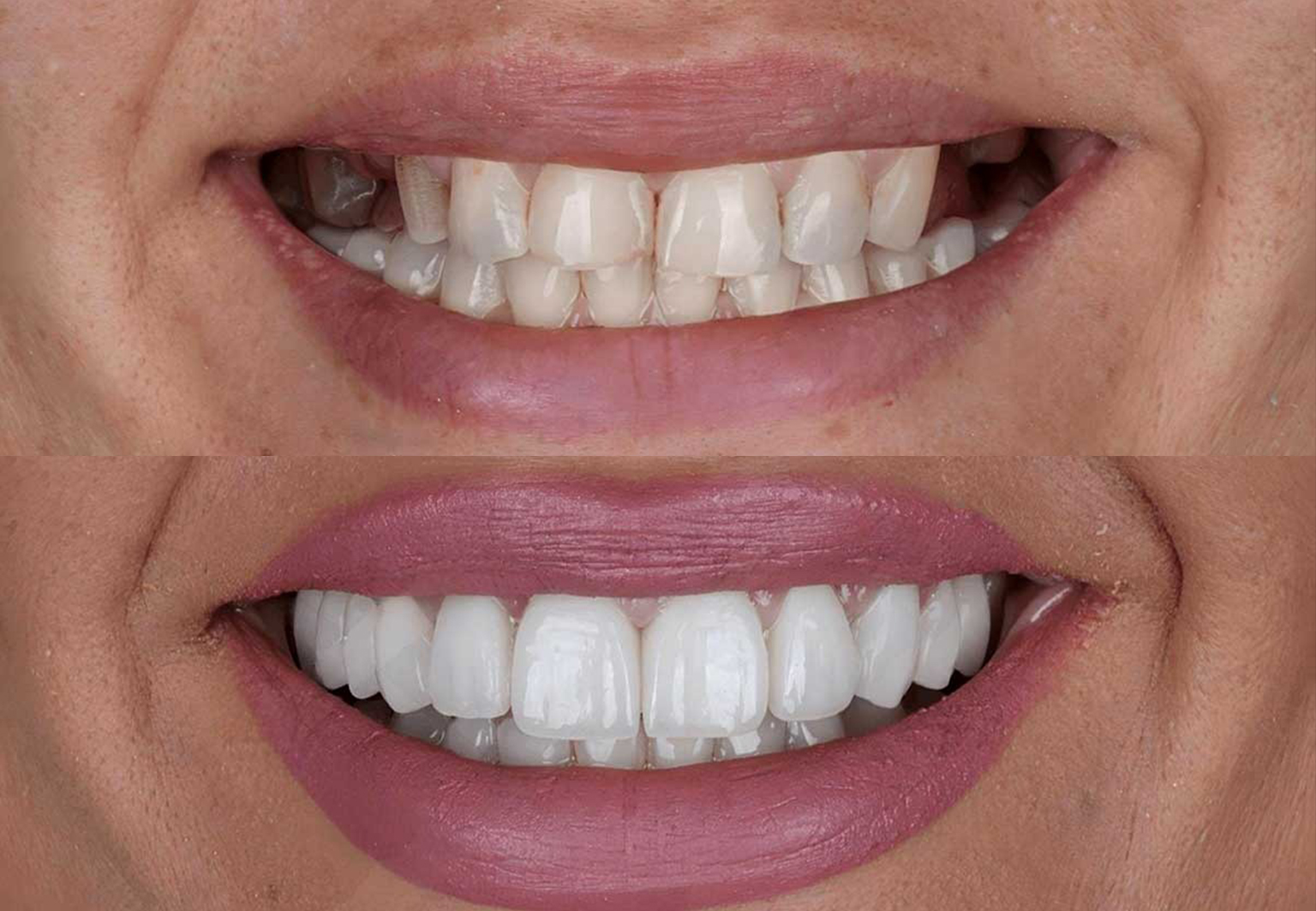 CareBridge - Cosmetic Dentistry - Before and after [12]