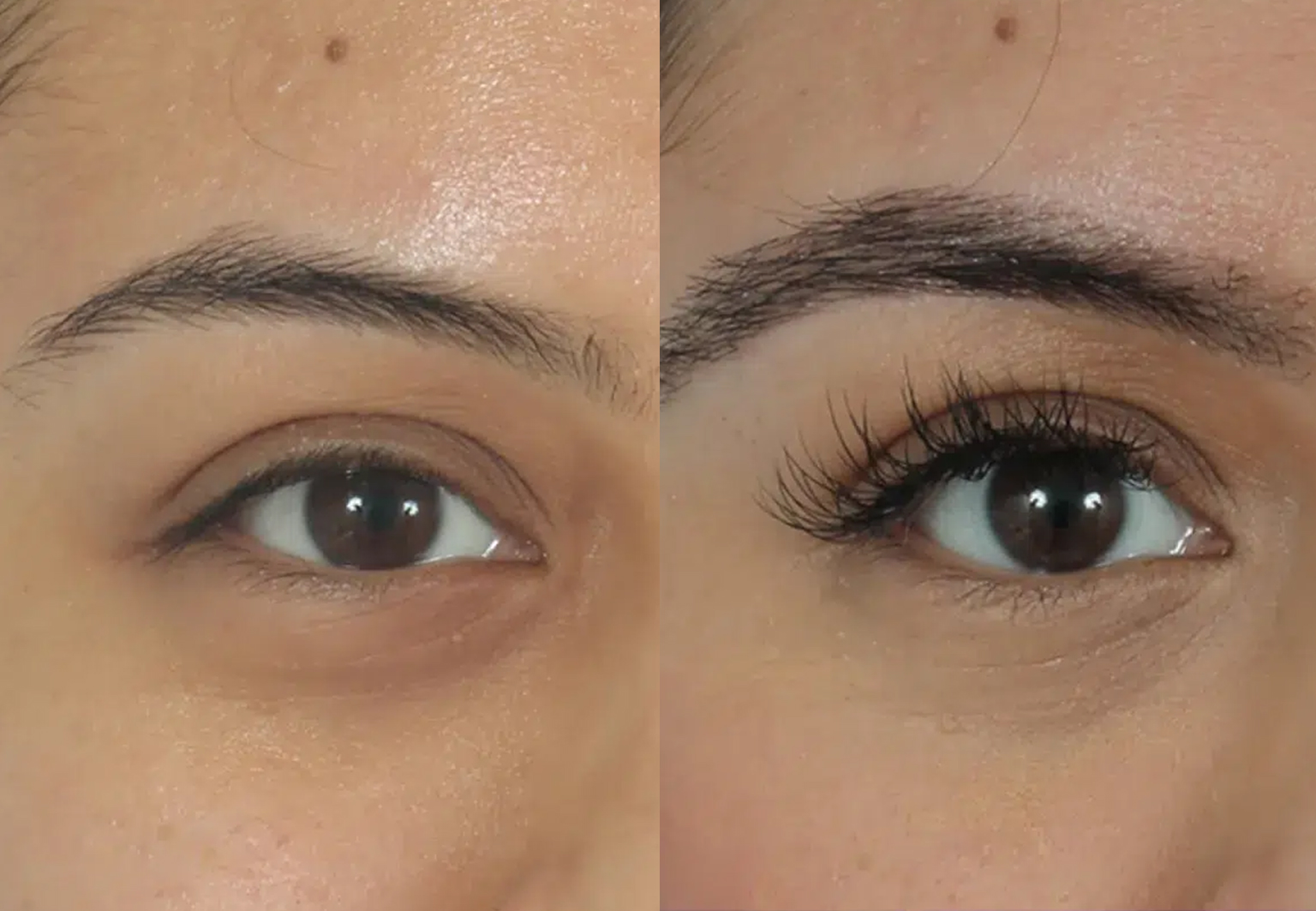 CareBridge - Eyebrow Transplant - Before and after [01]